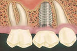 Рекомендации по уходу за зубами после имплантации
