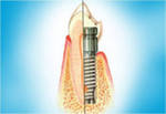 Виды зубных имплантов